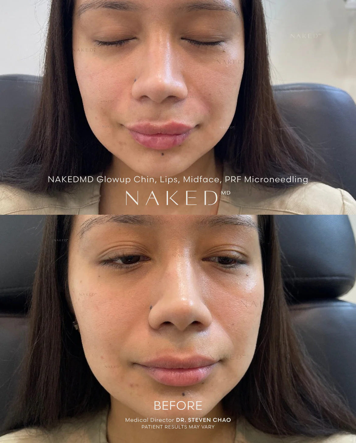Cheek Filler | New Client Offer - Image 3