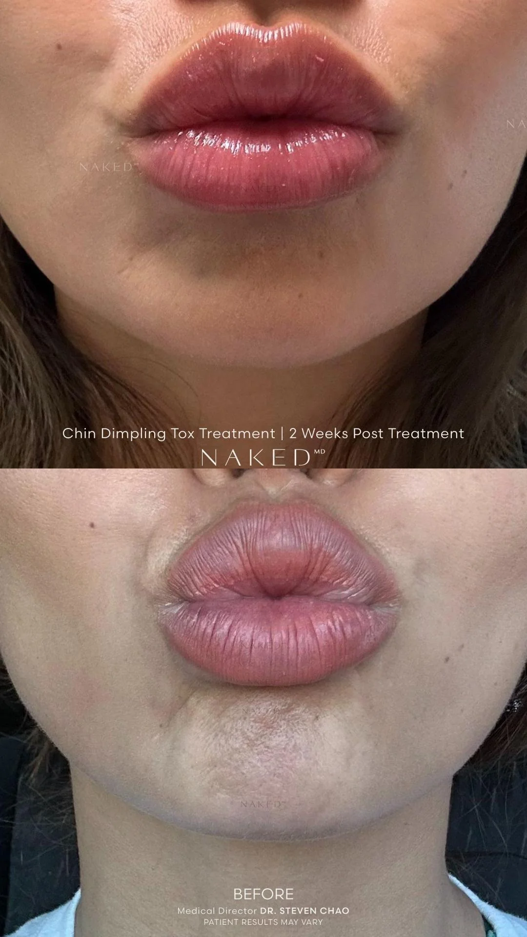 Chin Dimpling - Image 4