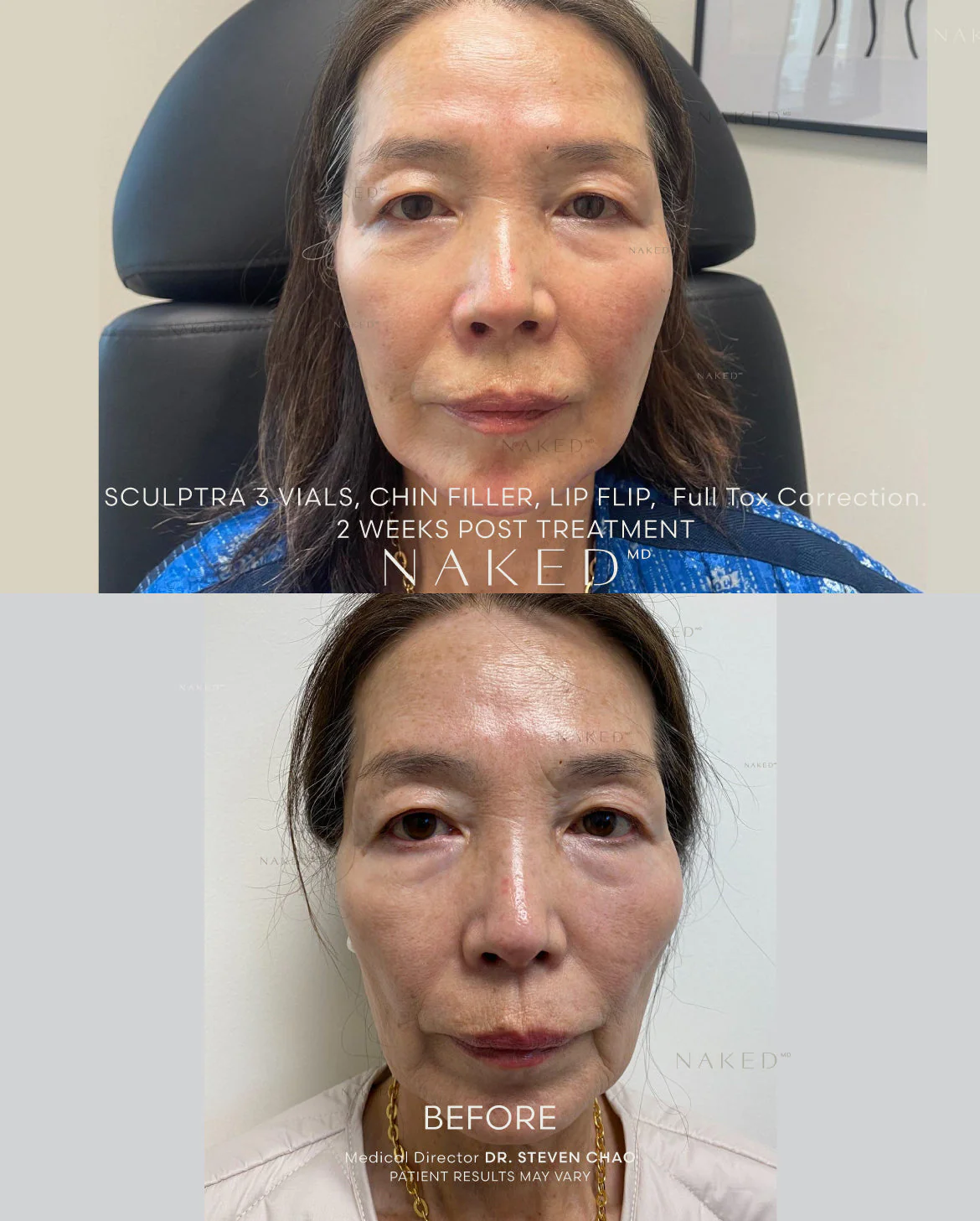 Chin Filler | New Client Offer - Image 13