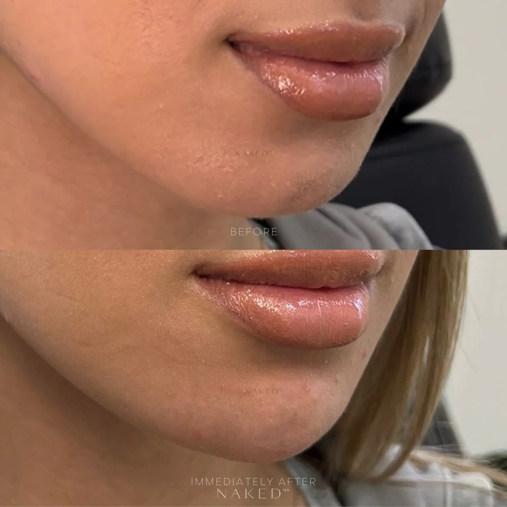 Chin Filler | New Client Offer - Image 3