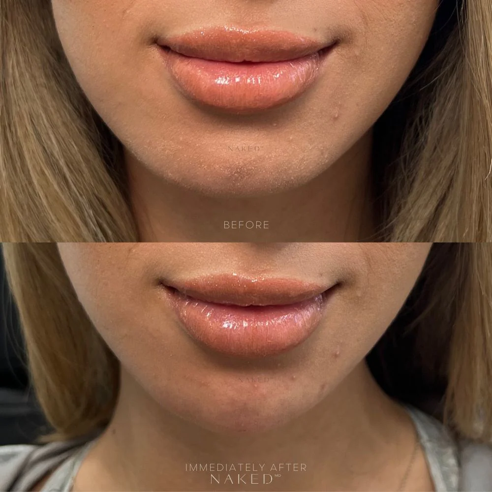 Chin Filler | New Client Offer - Image 4