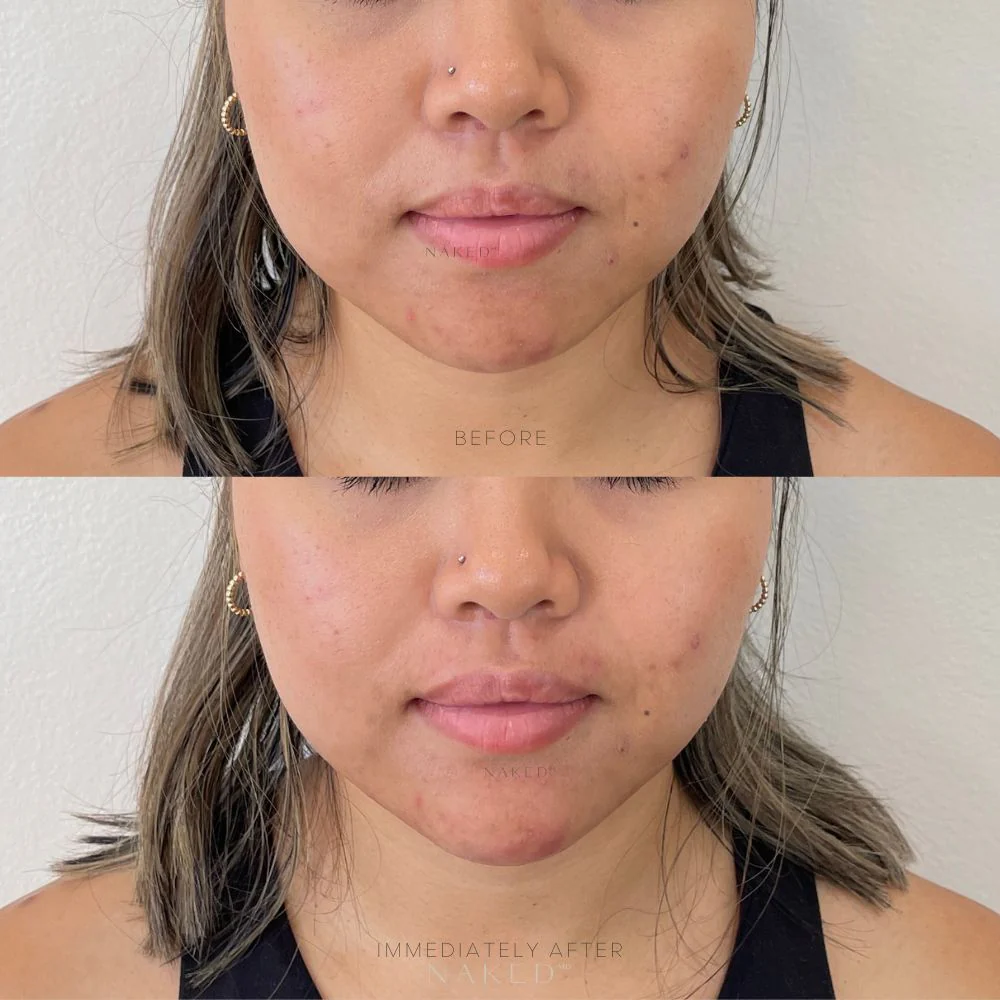 Chin Filler | New Client Offer - Image 5
