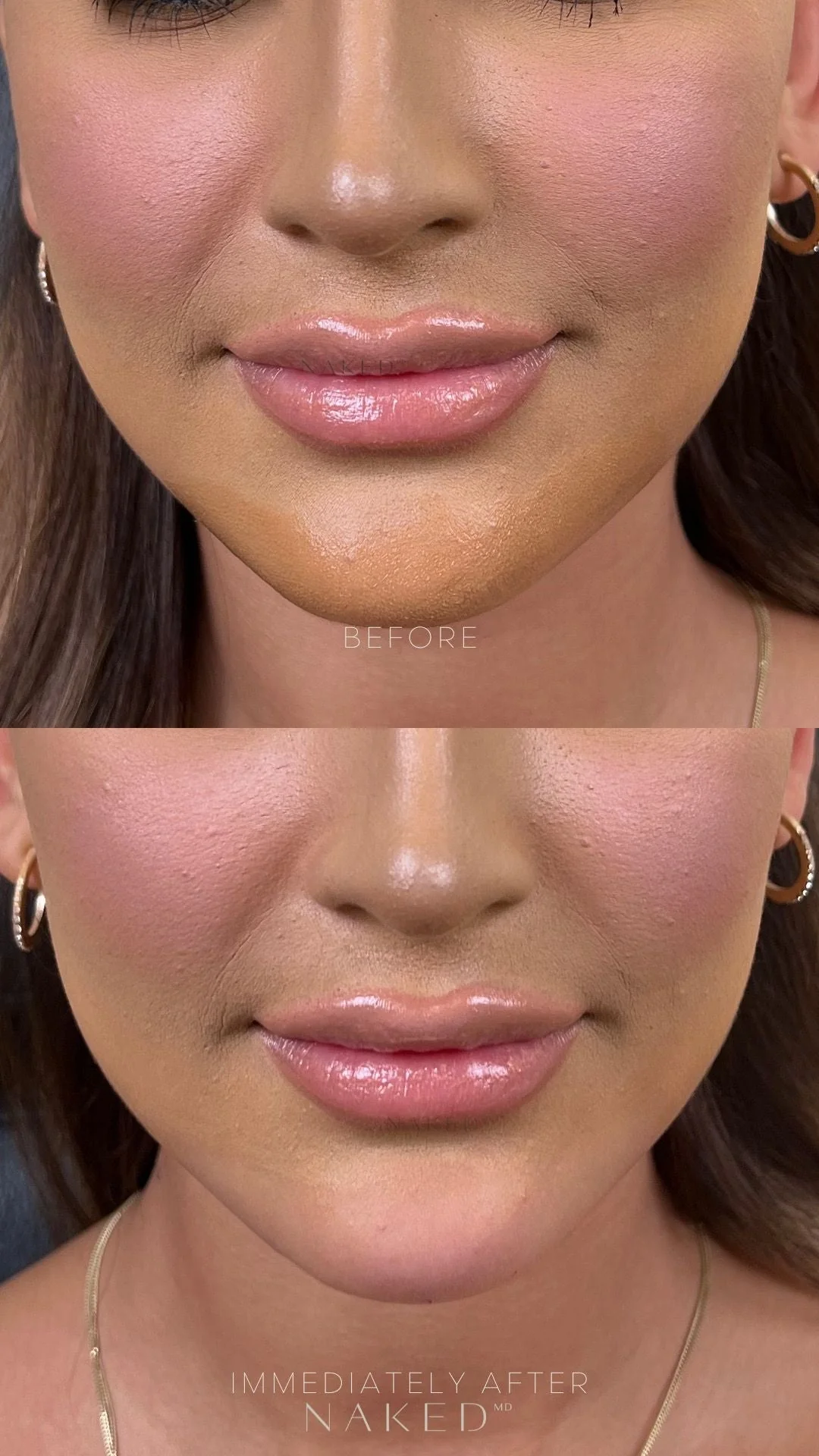 Chin Filler | New Client Offer - Image 6