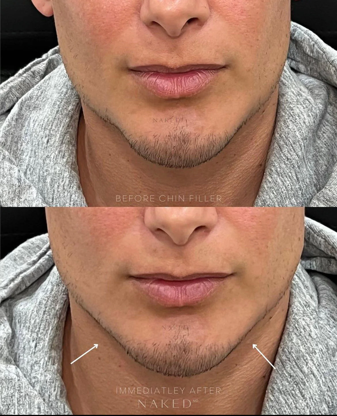 Chin Filler | New Client Offer - Image 9