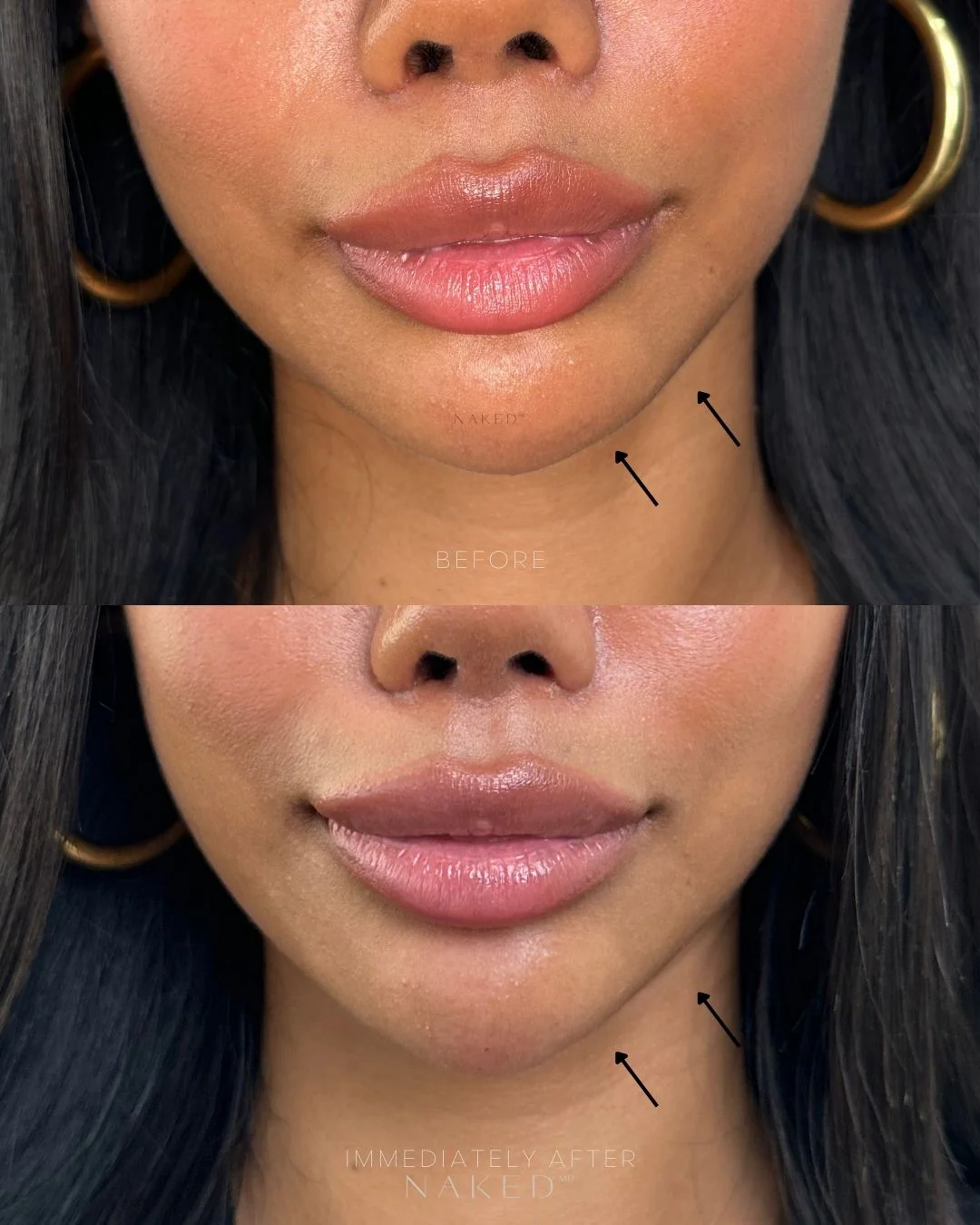 Chin Filler - Image 12