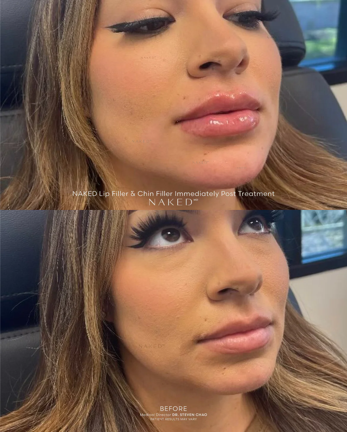 Chin Filler - Image 13