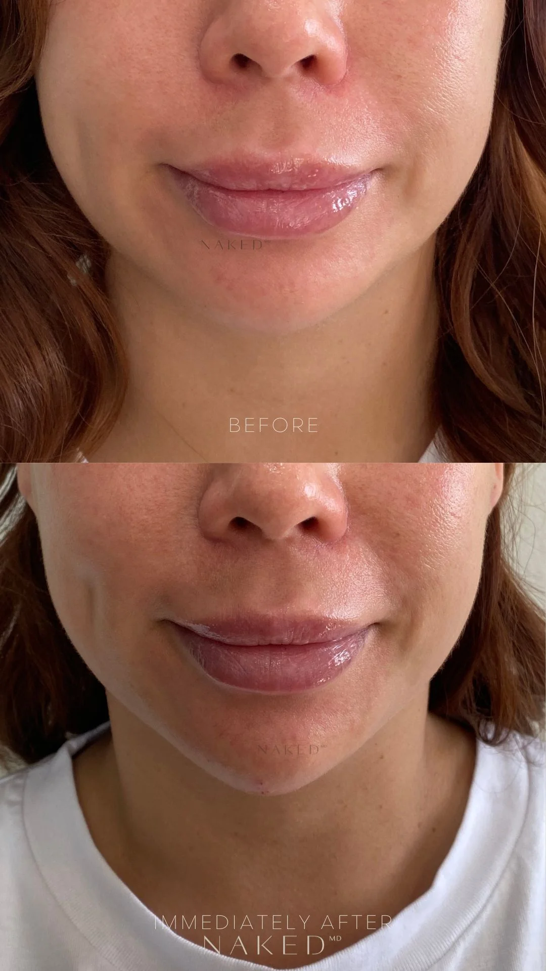 Chin Filler - Image 8