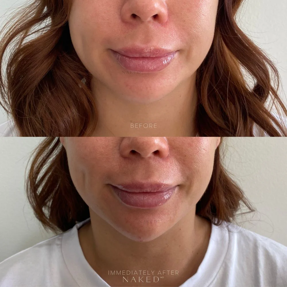 Chin Filler - Image 9