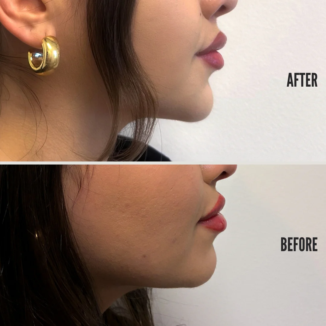 Chin Sprinkle - Image 3