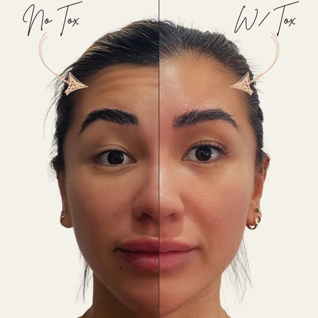 Forehead TOX | New Client Offer - Image 3