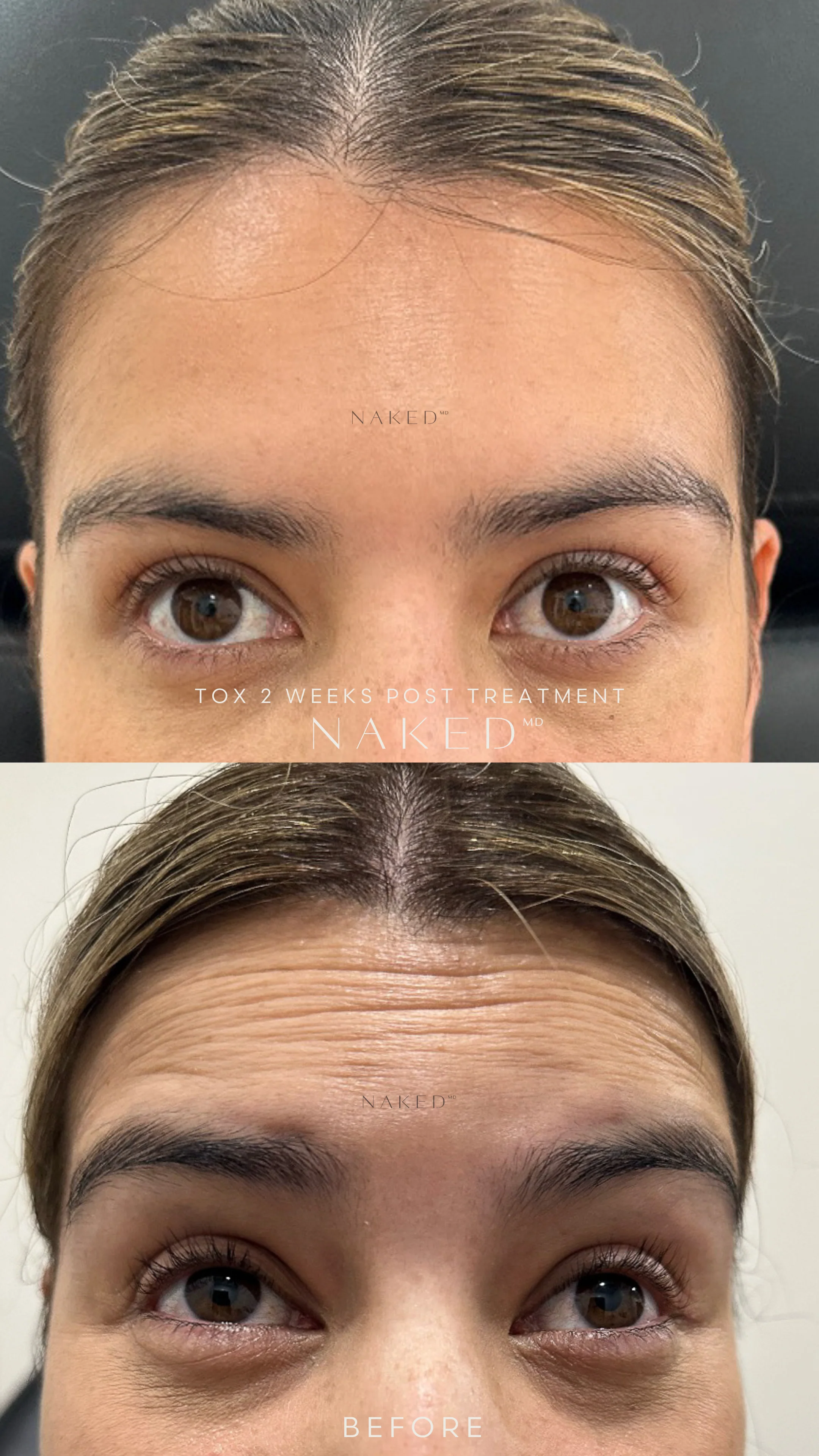 Forehead TOX | New Client Offer - Image 4