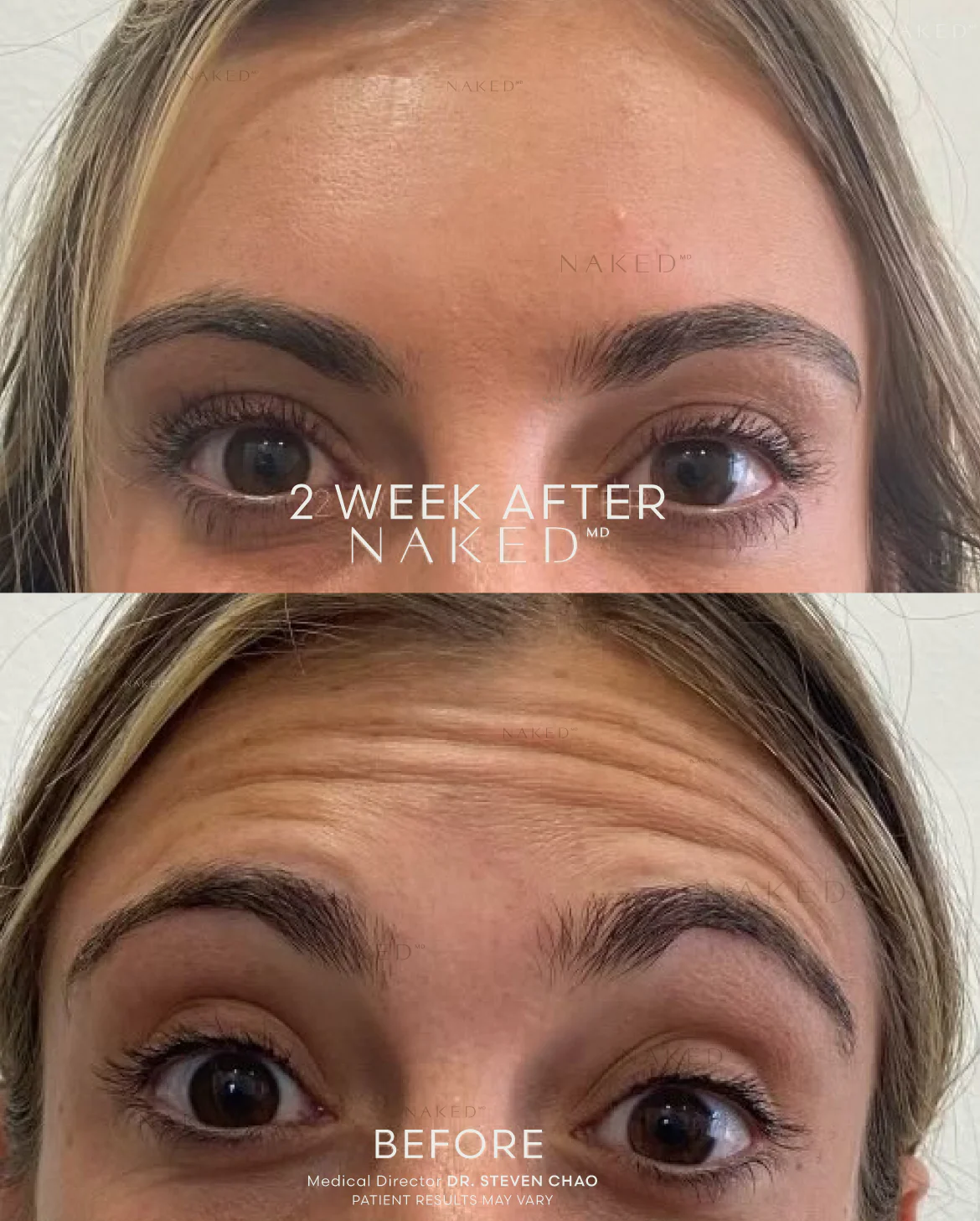 Forehead TOX | New Client Offer - Image 5