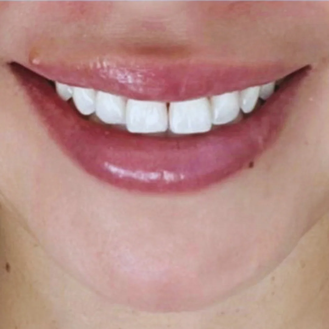 Gummy Smile - Image 6