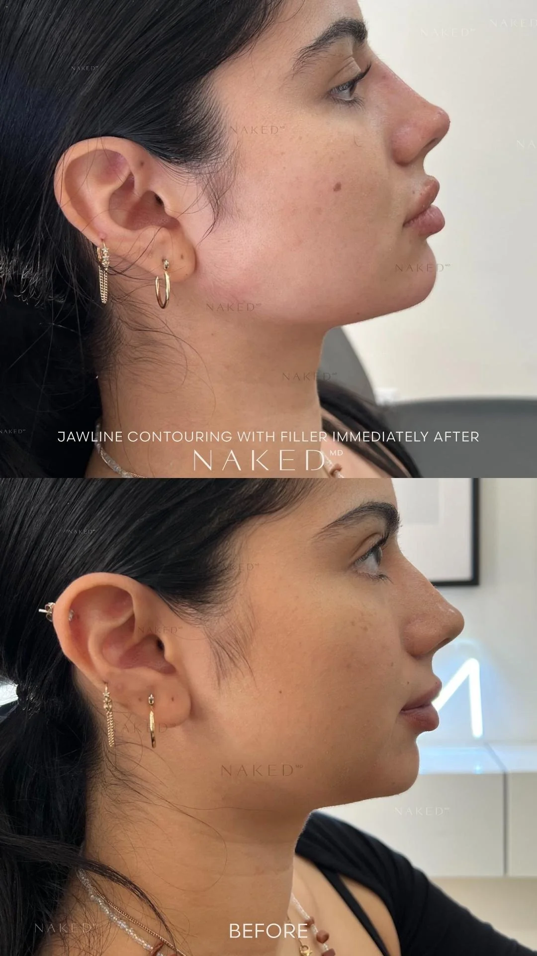 Jawline Contour Filler | New Client Offer - Image 4