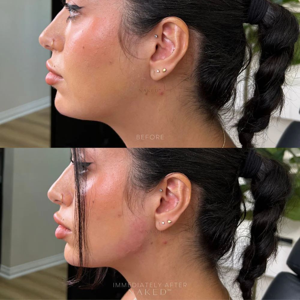 Jawline Contour Filler | New Client Offer - Image 5