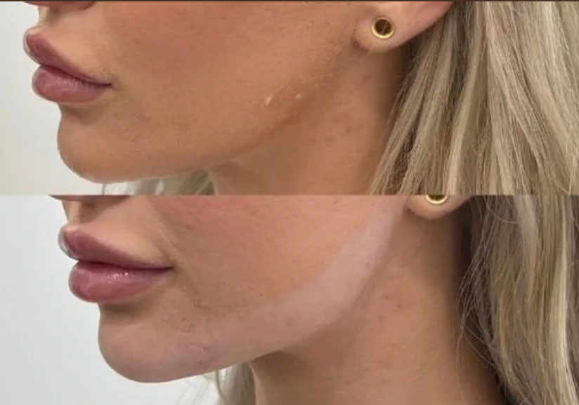 Jawline Contour Filler | New Client Offer - Image 6
