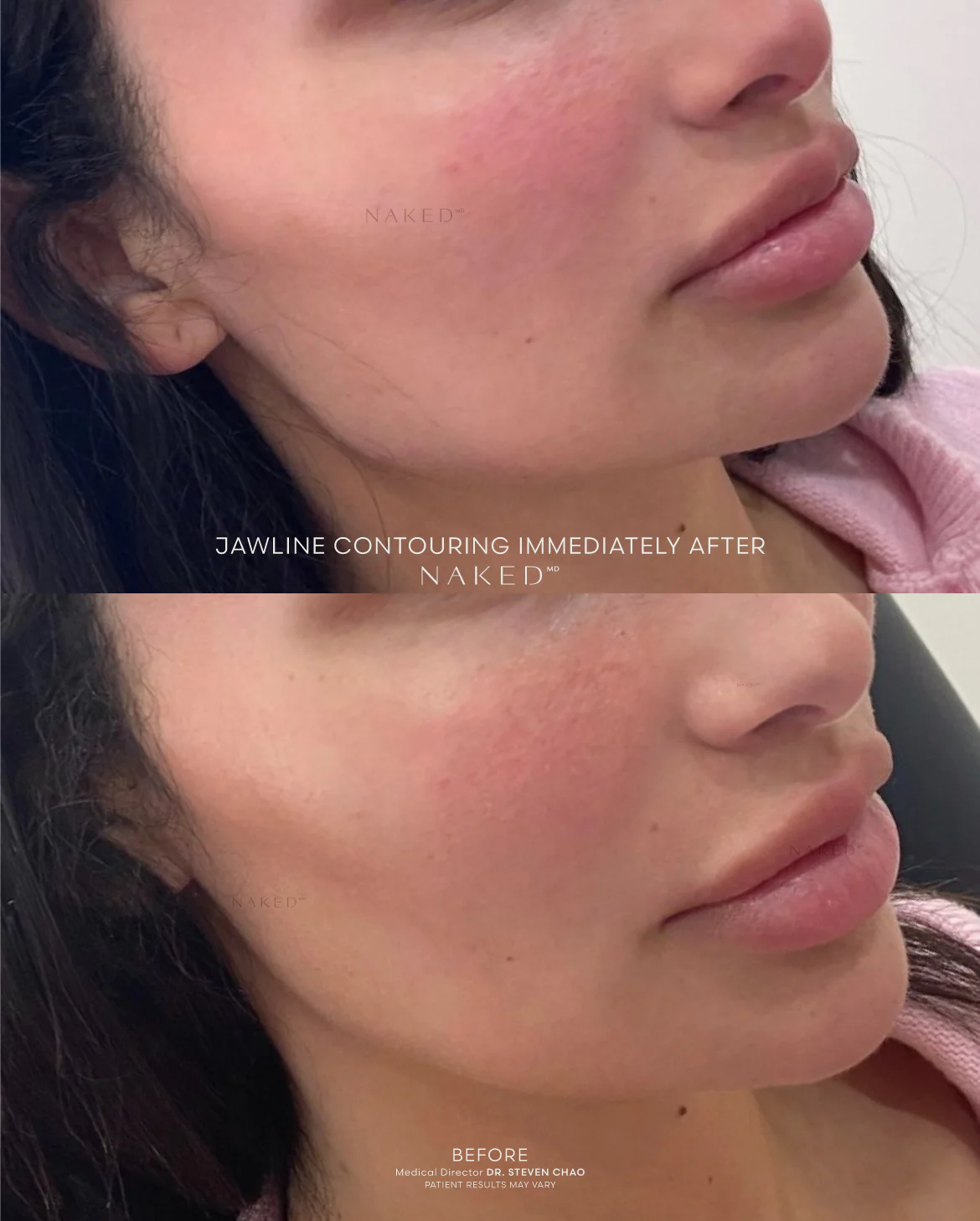 Jawline Contour Filler | New Client Offer - Image 7
