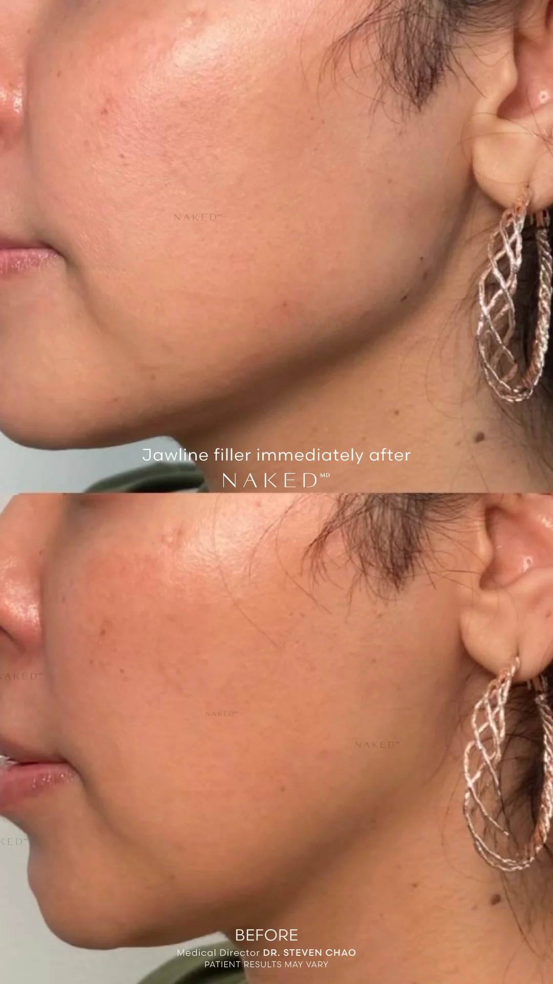 Jawline Contour Filler | New Client Offer - Image 8