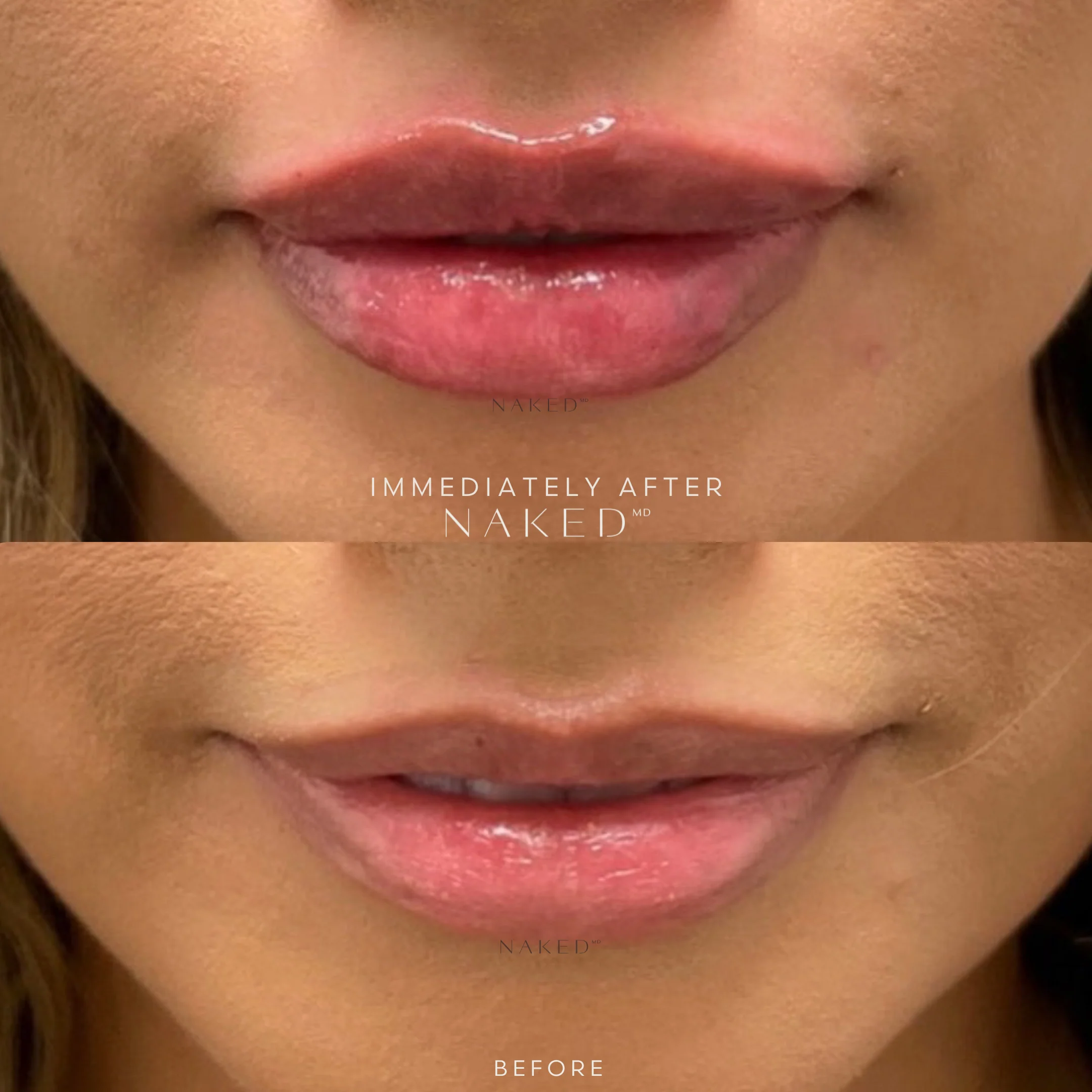 Naked Lips | Lip Filler - Image 10