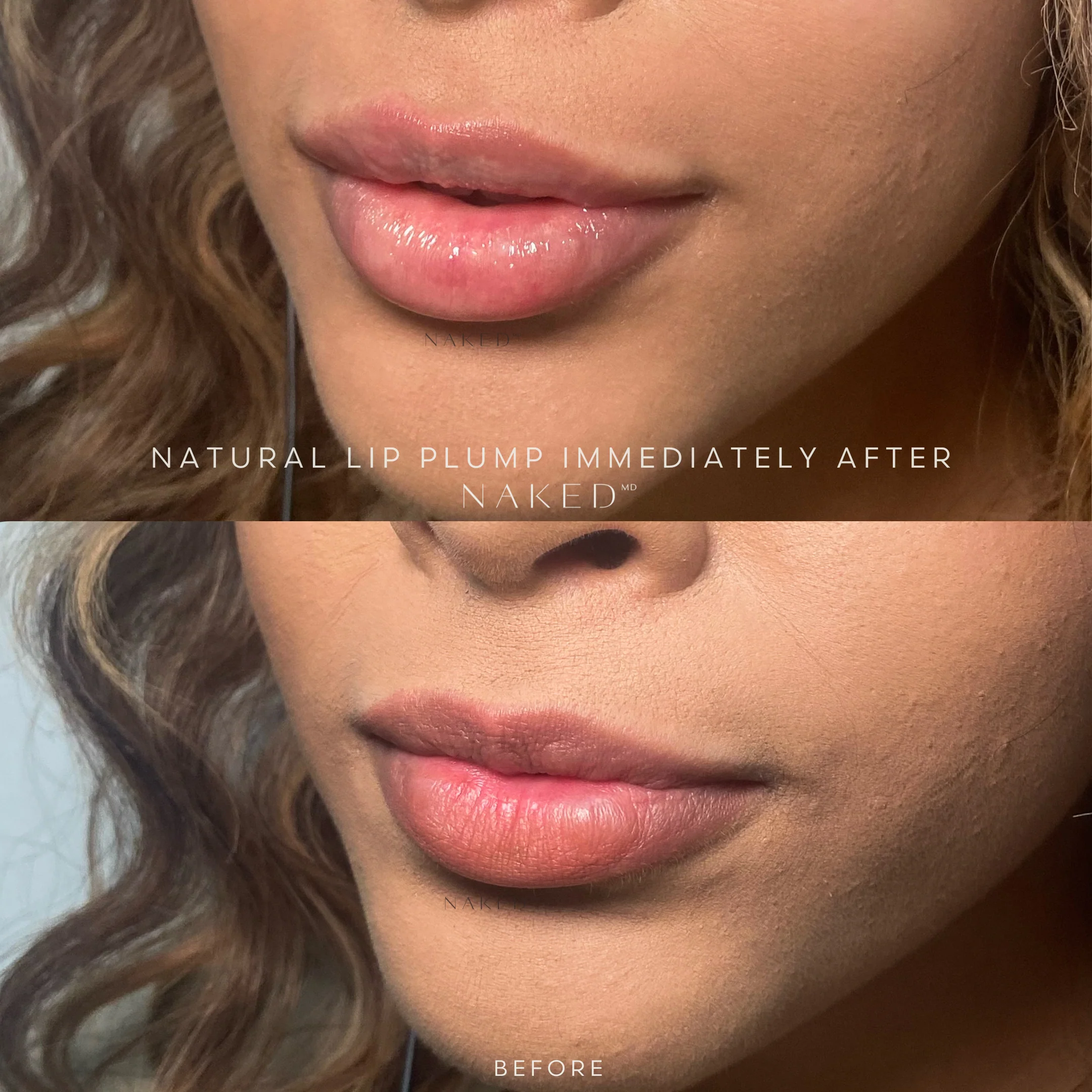 Naked Lips | Lip Filler - Image 13