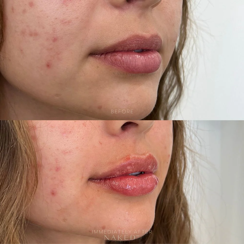 Naked Lips | Lip Filler - Image 15