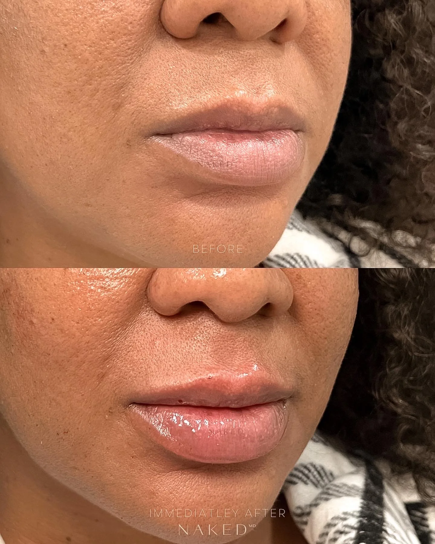 Naked Lips | Lip Filler - Image 18