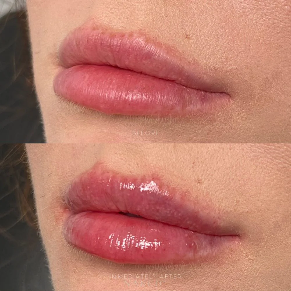 Naked Lips | Lip Filler - Image 19