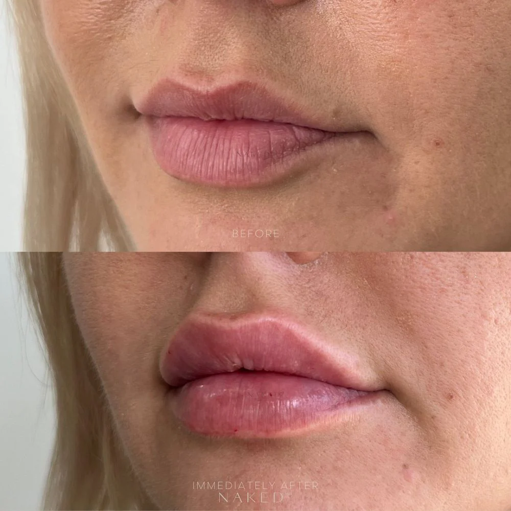 Naked Lips | Lip Filler - Image 21