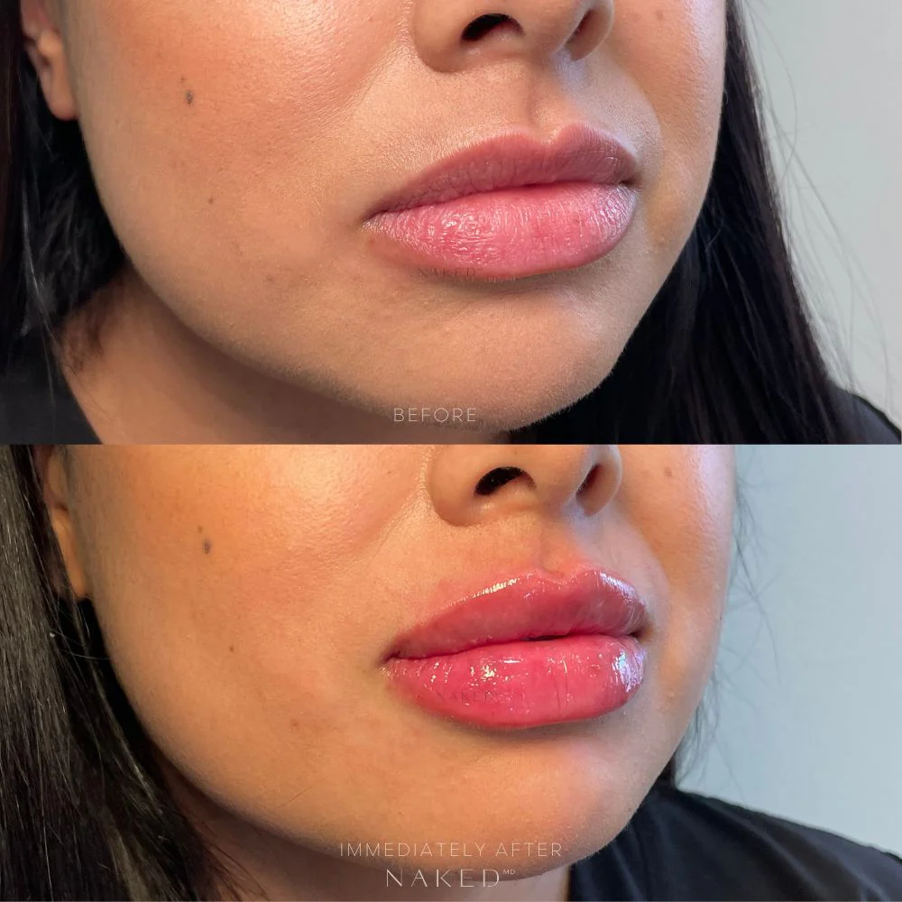 Naked Lips | Lip Filler - Image 25