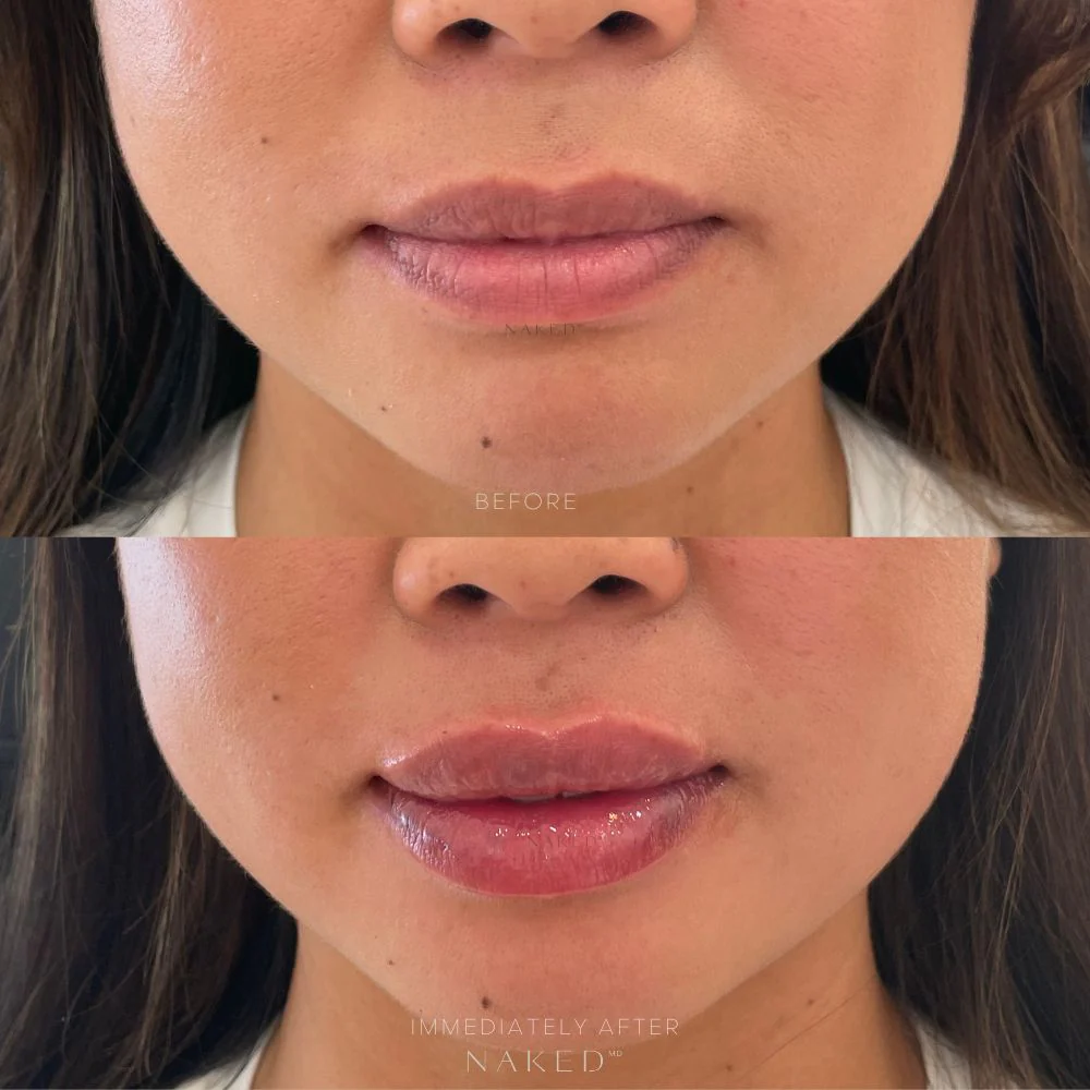 Naked Lips | Lip Filler - Image 26
