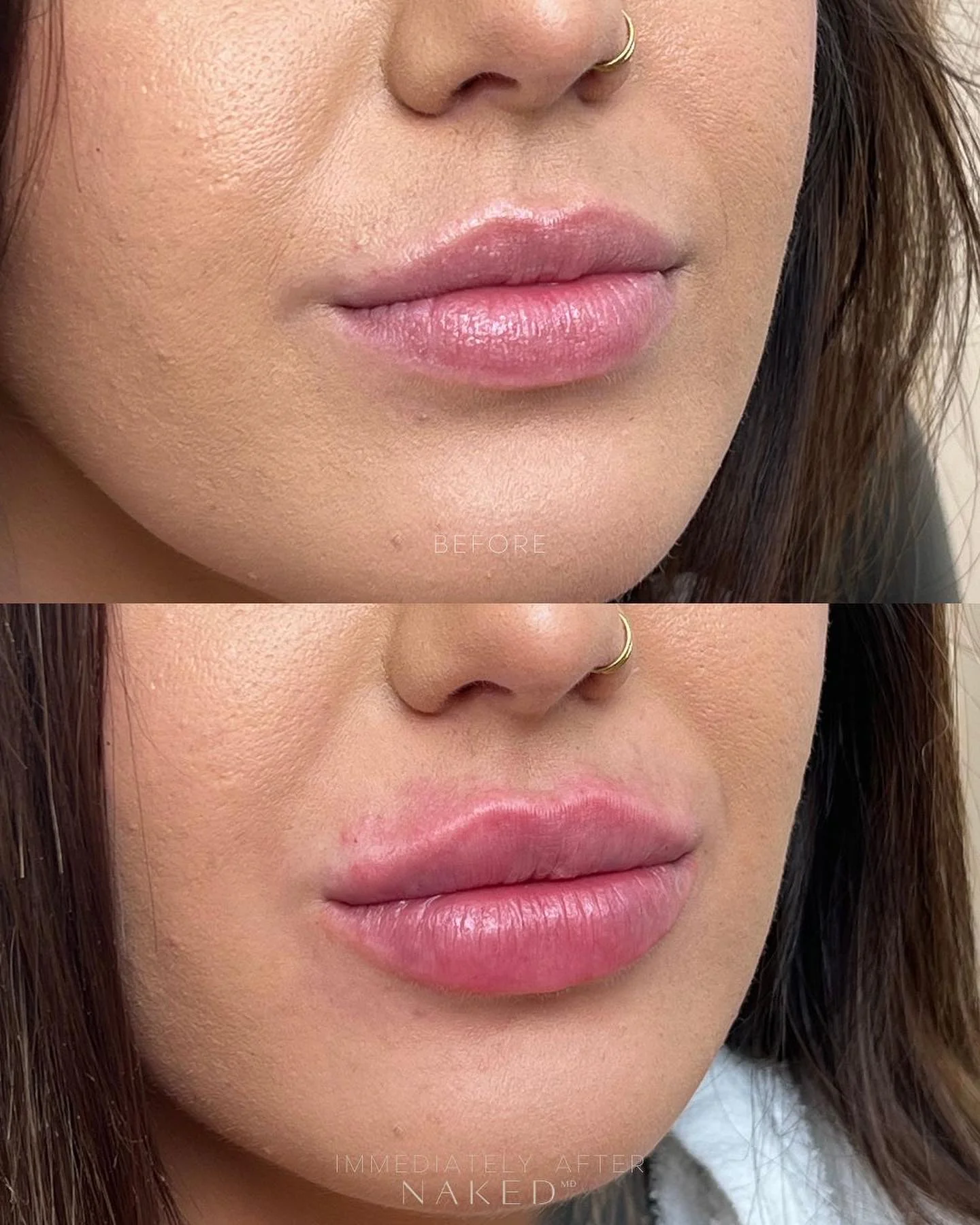 Naked Lips | Lip Filler - Image 30