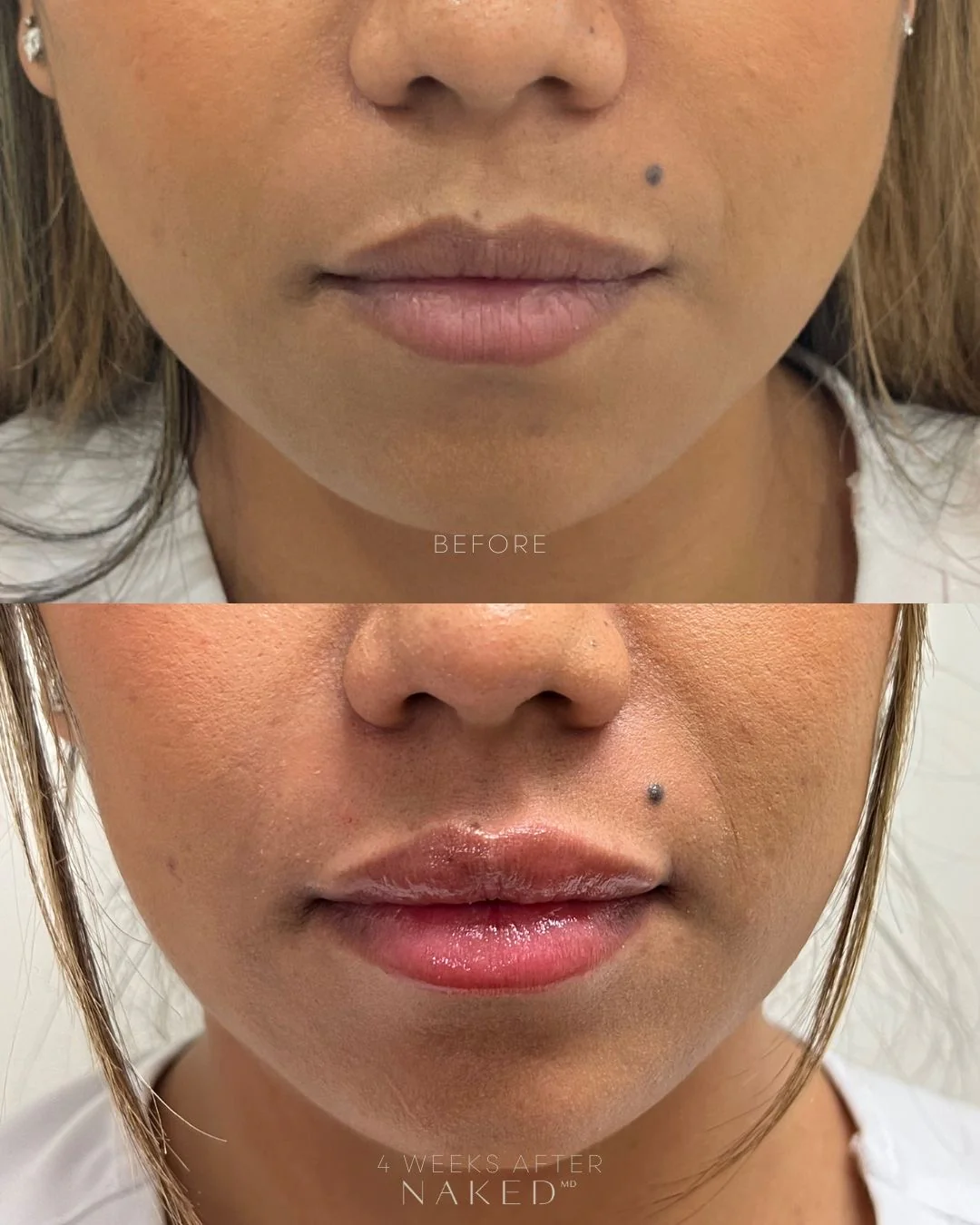Naked Lips | Lip Filler - Image 31