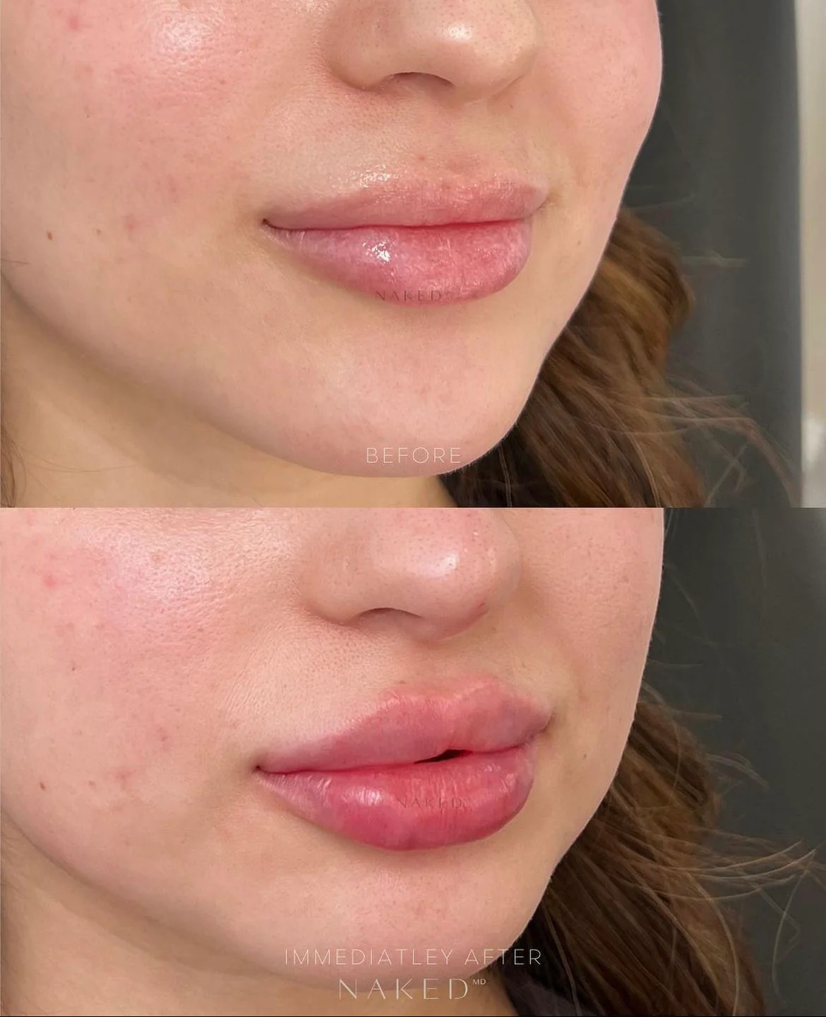 Naked Lips | Lip Filler - Image 32