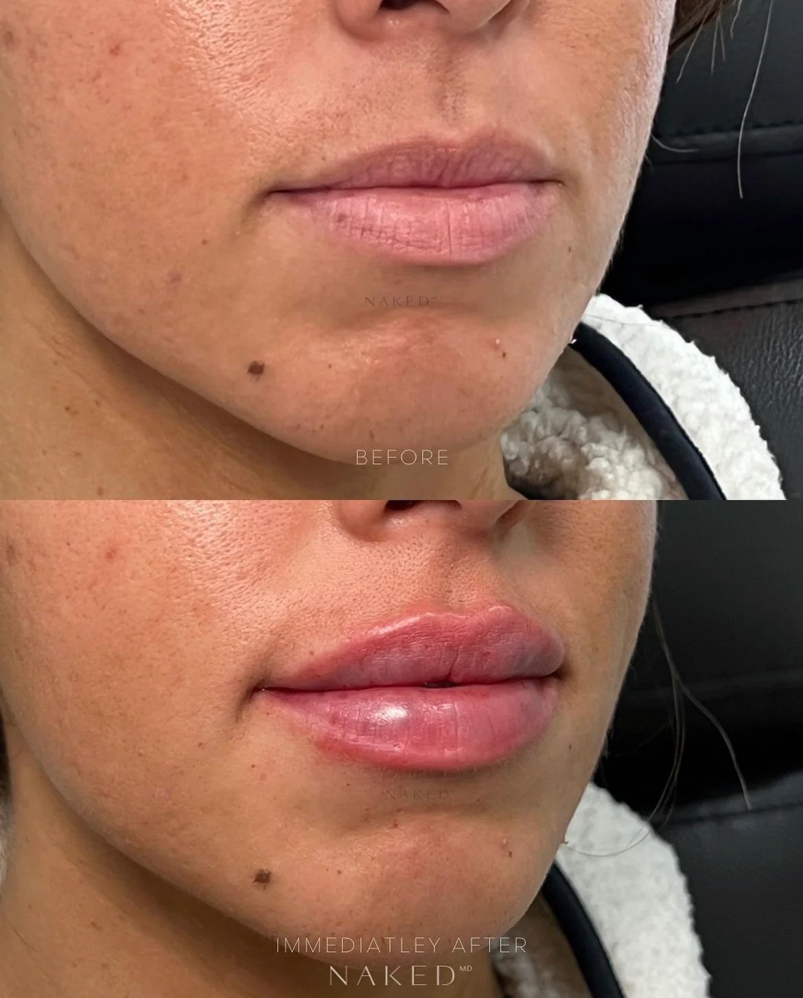 Naked Lips | Lip Filler - Image 33