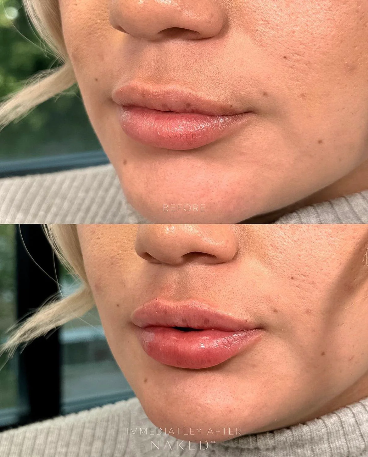 Naked Lips | Lip Filler - Image 35