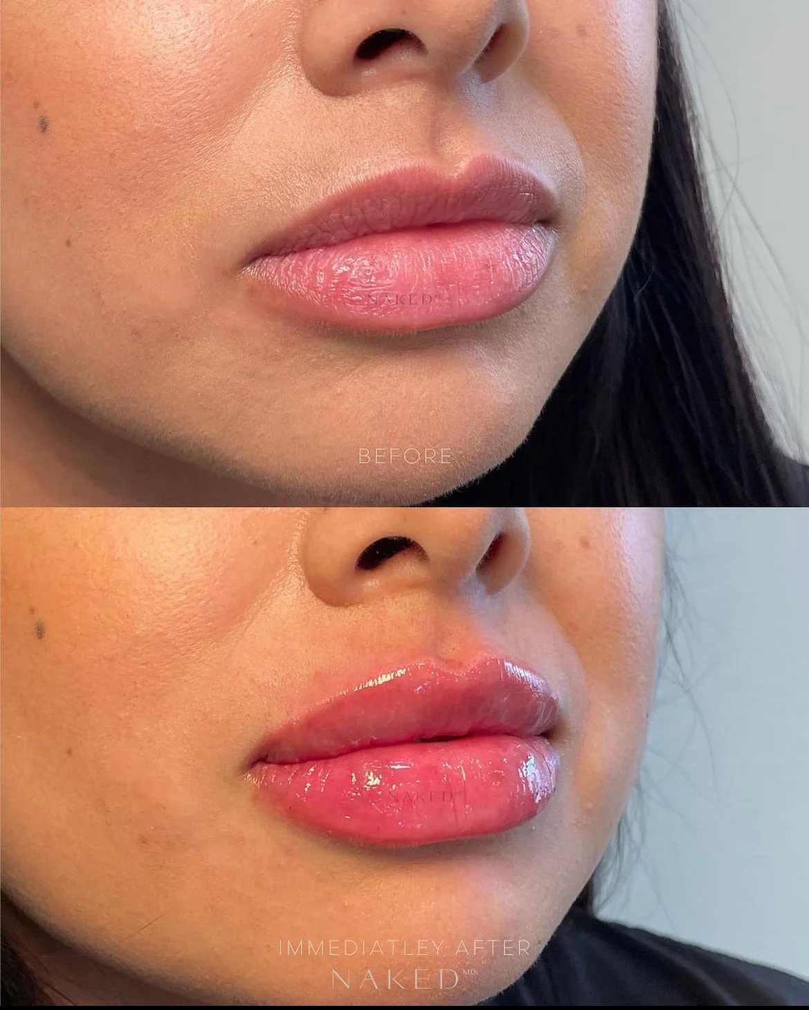 Naked Lips | Lip Filler - Image 36