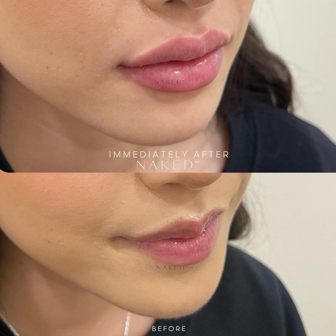 Naked Lips | Lip Filler - Image 38