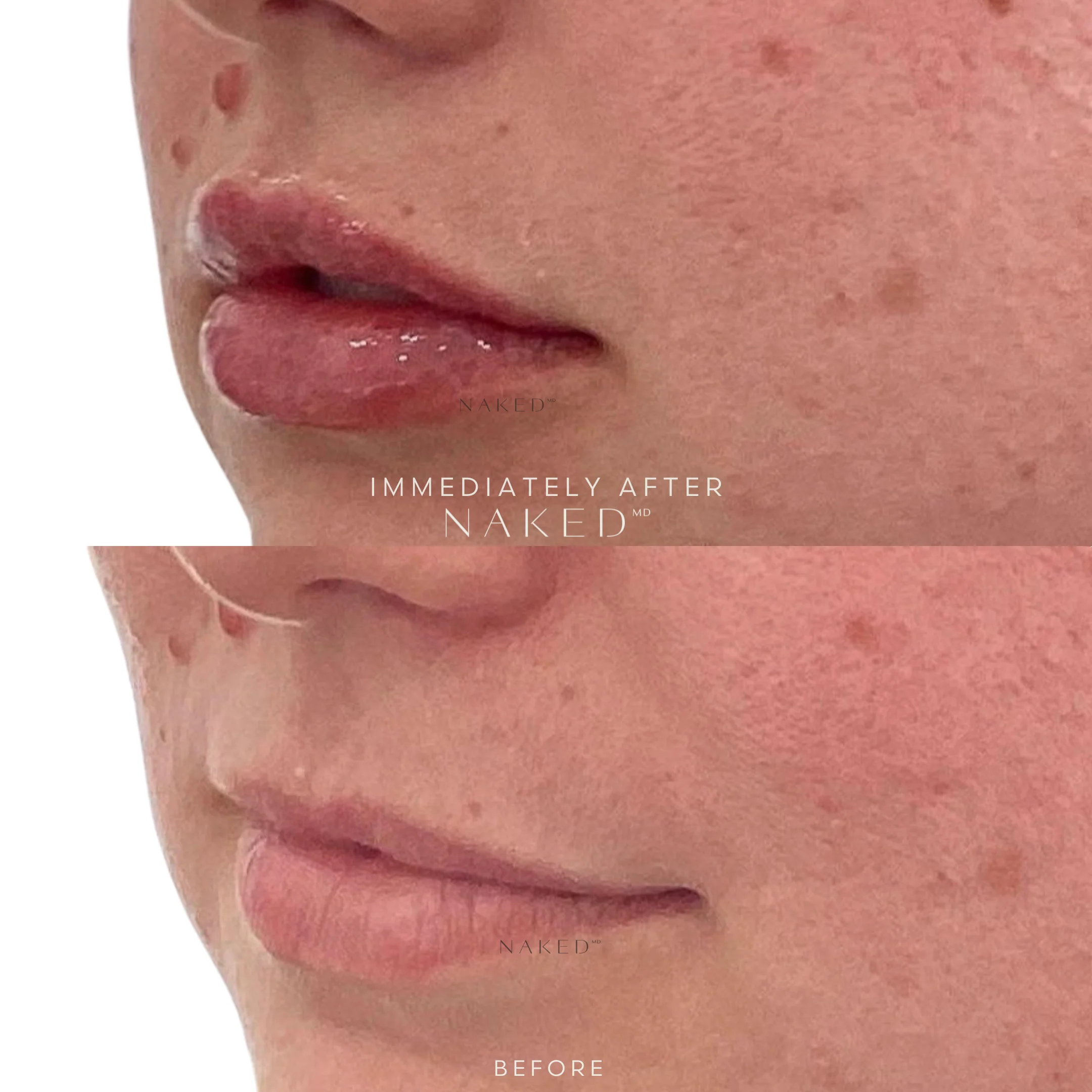 Naked Lips | Lip Filler - Image 39