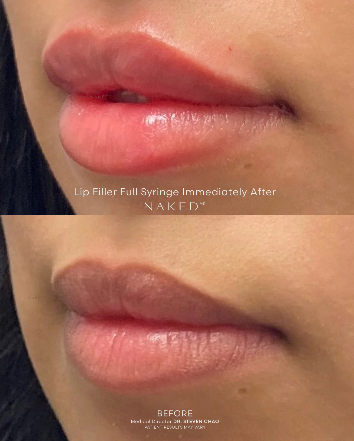 Naked Lips | Lip Filler - Image 4