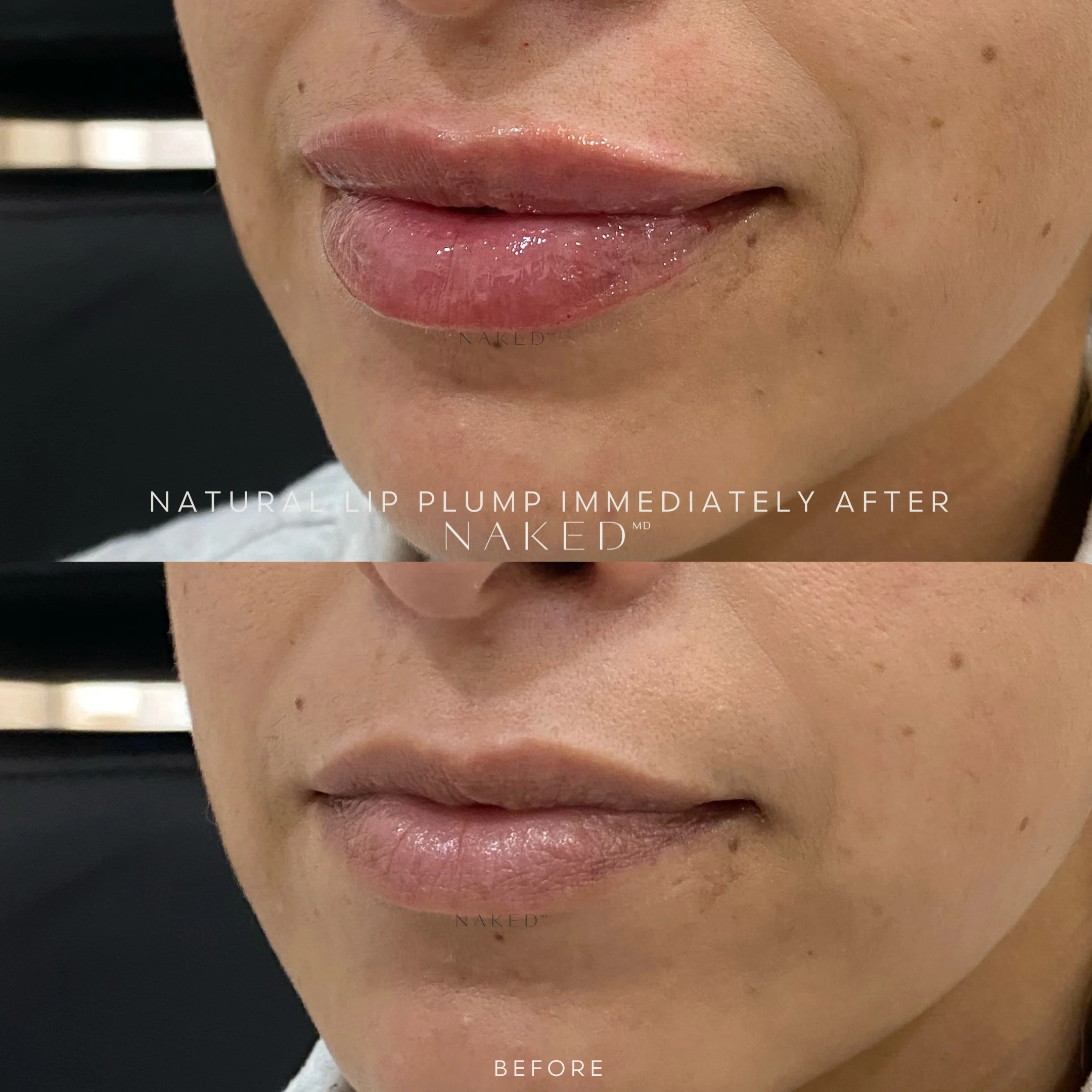 Naked Lips | Lip Filler - Image 40