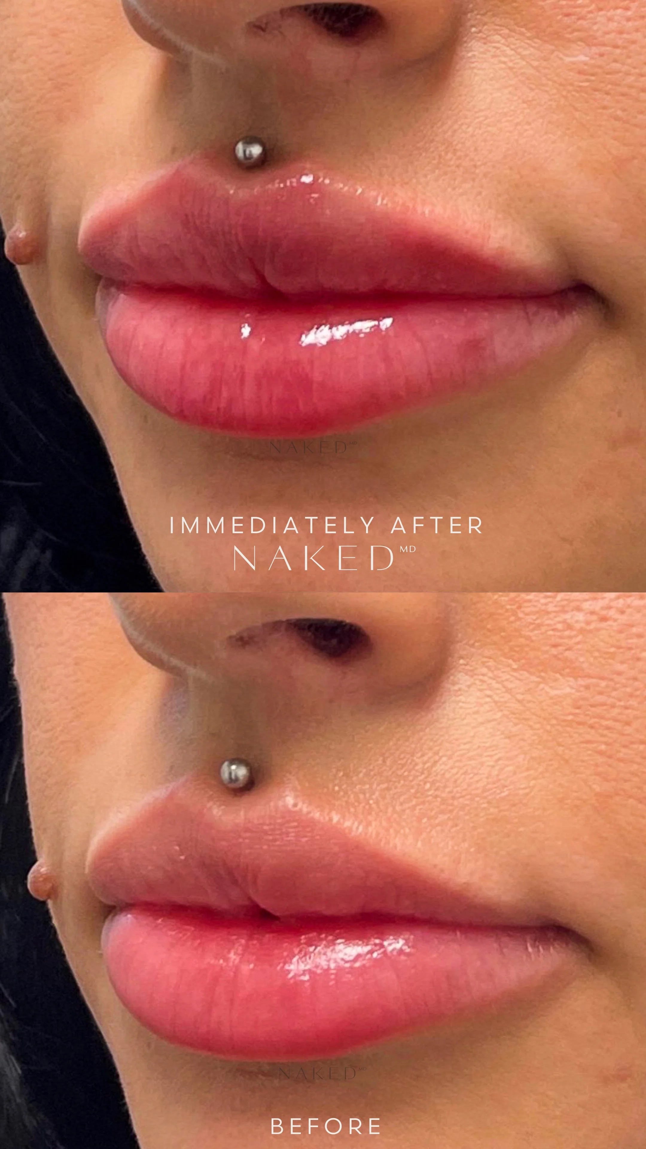 Naked Lips | Lip Filler - Image 41