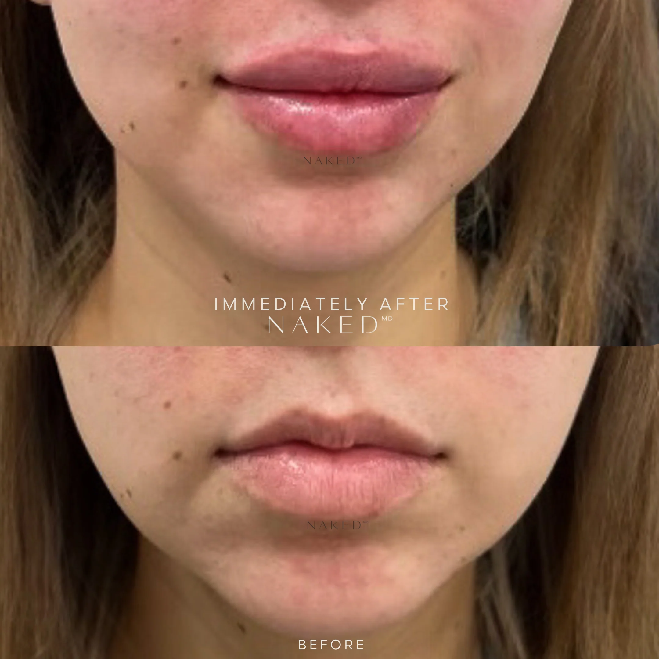 Naked Lips | Lip Filler - Image 46
