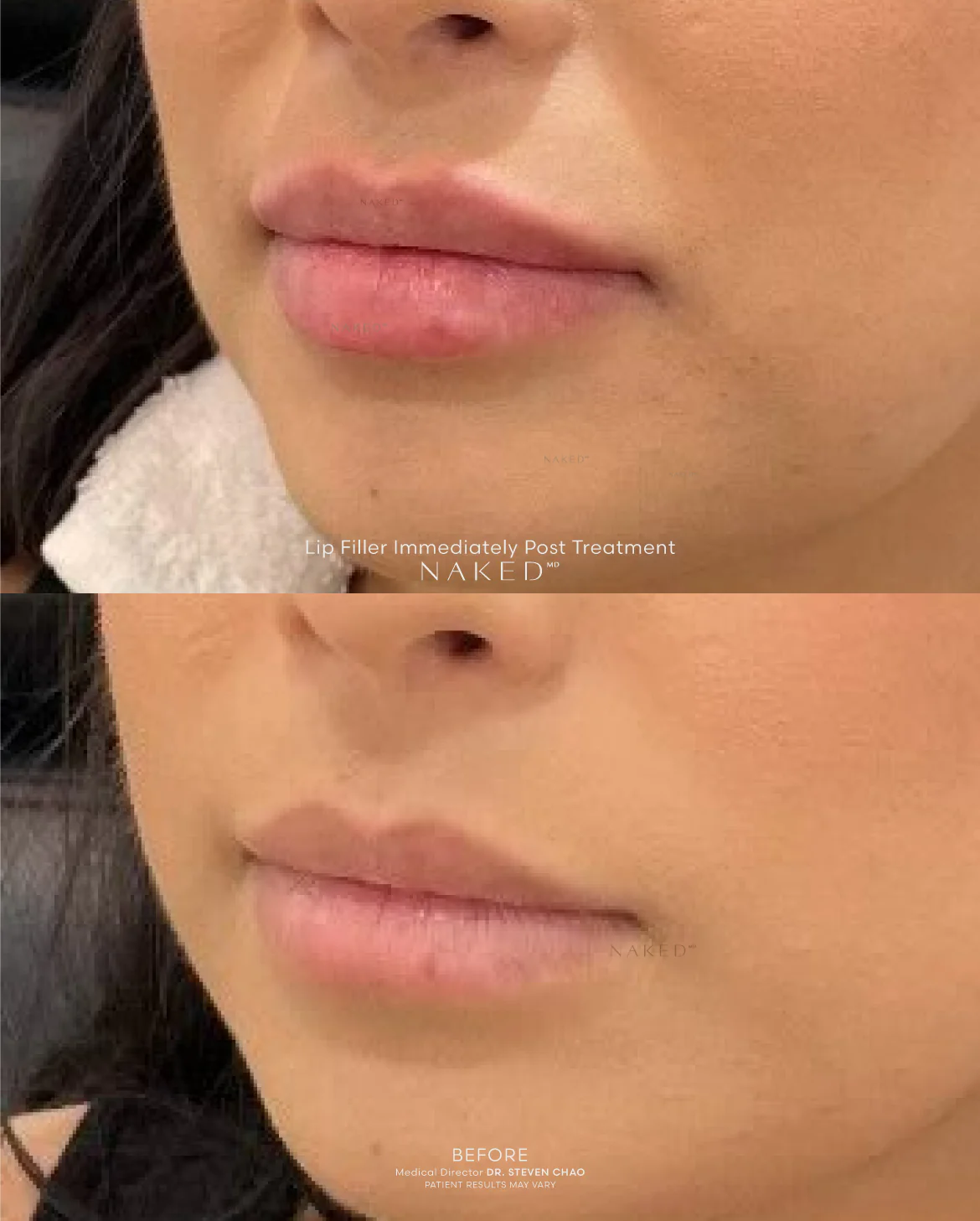 Naked Lips | Lip Filler - Image 47