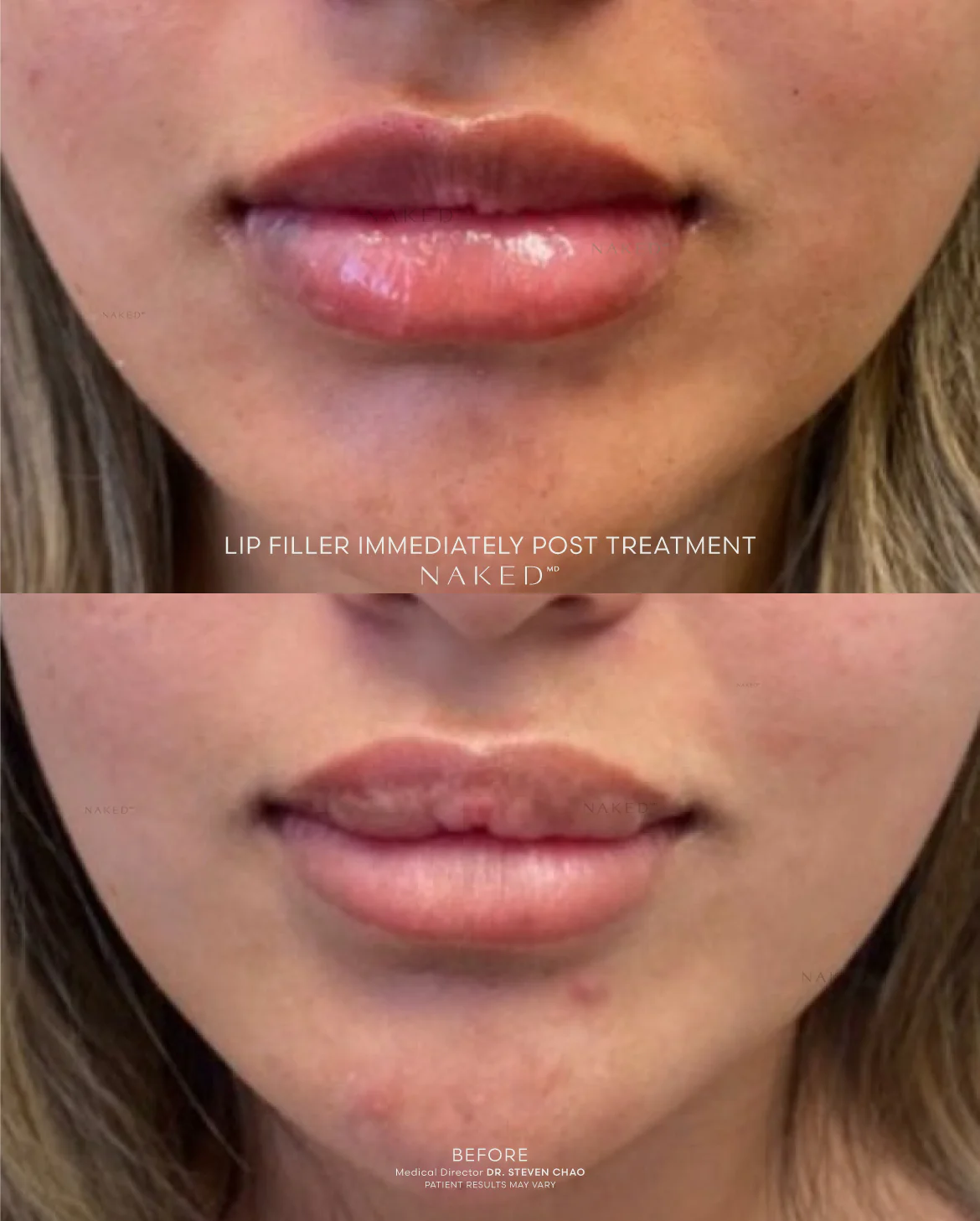 Naked Lips | Lip Filler - Image 48