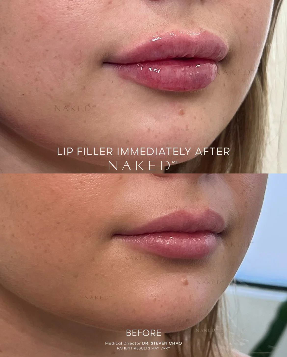 Naked Lips | Lip Filler - Image 49