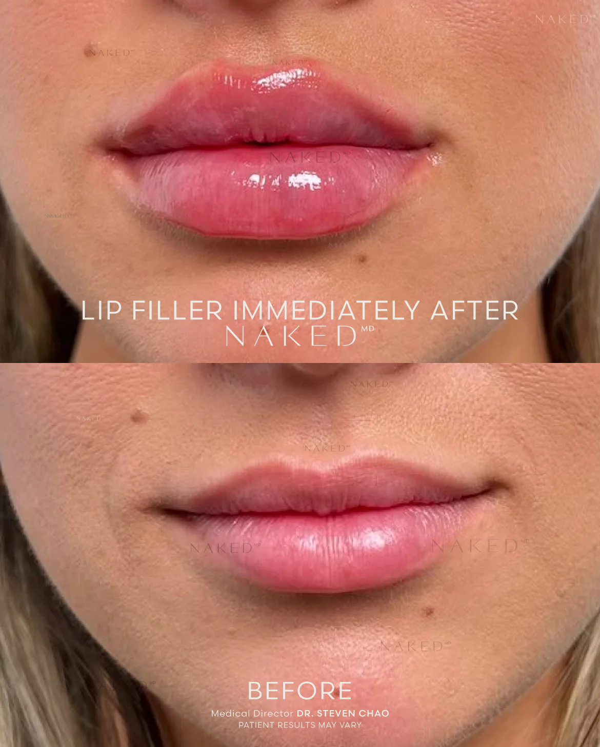 Naked Lips | Lip Filler - Image 50