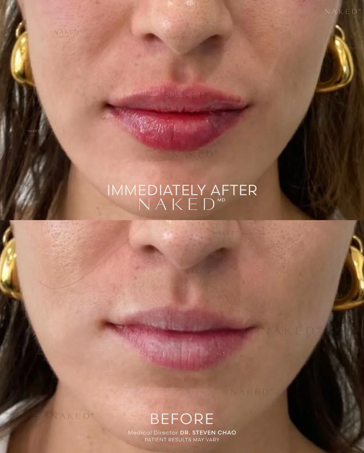 Naked Lips | Lip Filler - Image 51
