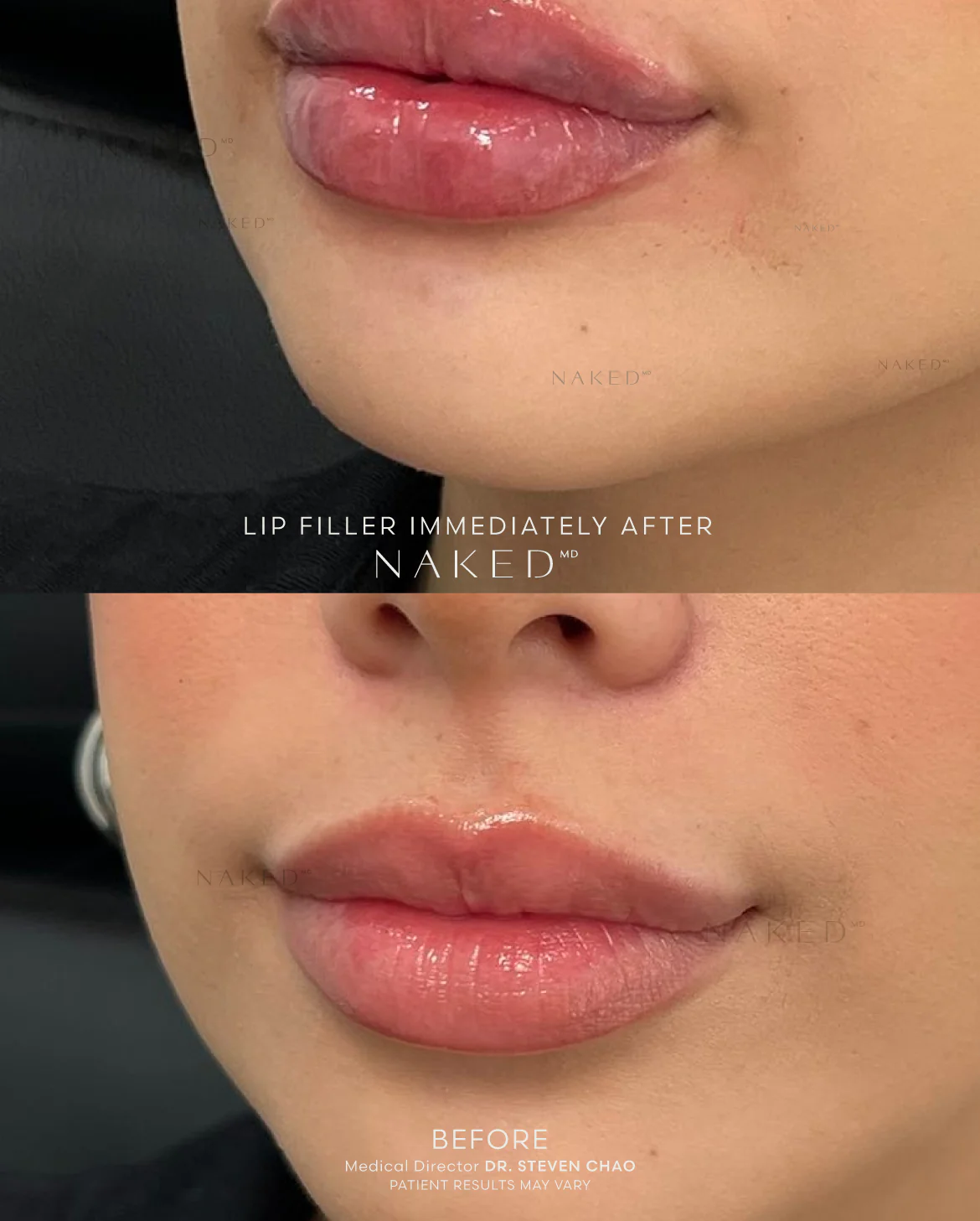 Naked Lips | Lip Filler - Image 52