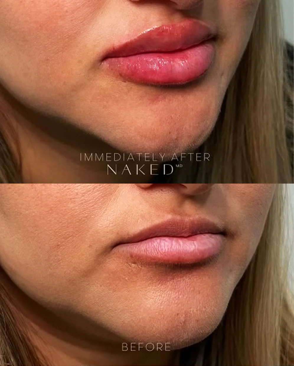 Naked Lips | Lip Filler - Image 53