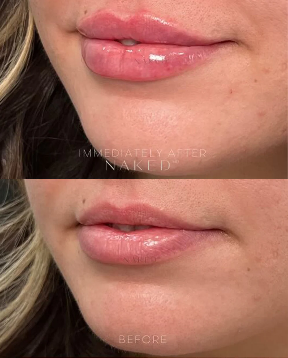 Naked Lips | Lip Filler - Image 54